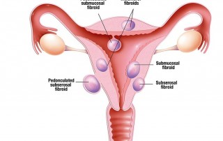 Fibroids Fertility