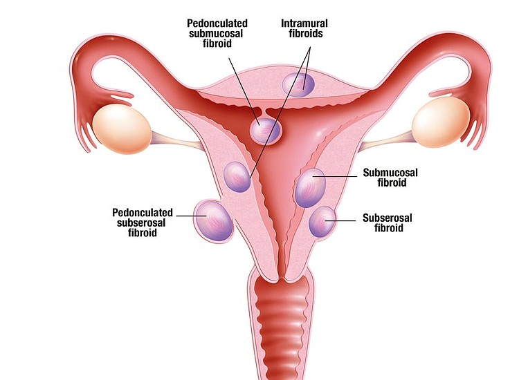 Fibroids Fertility